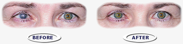 free-disfigured-eye-help-2