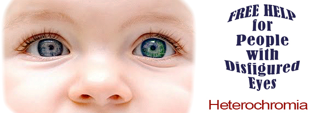 heterochromia-disfigured-eye-help