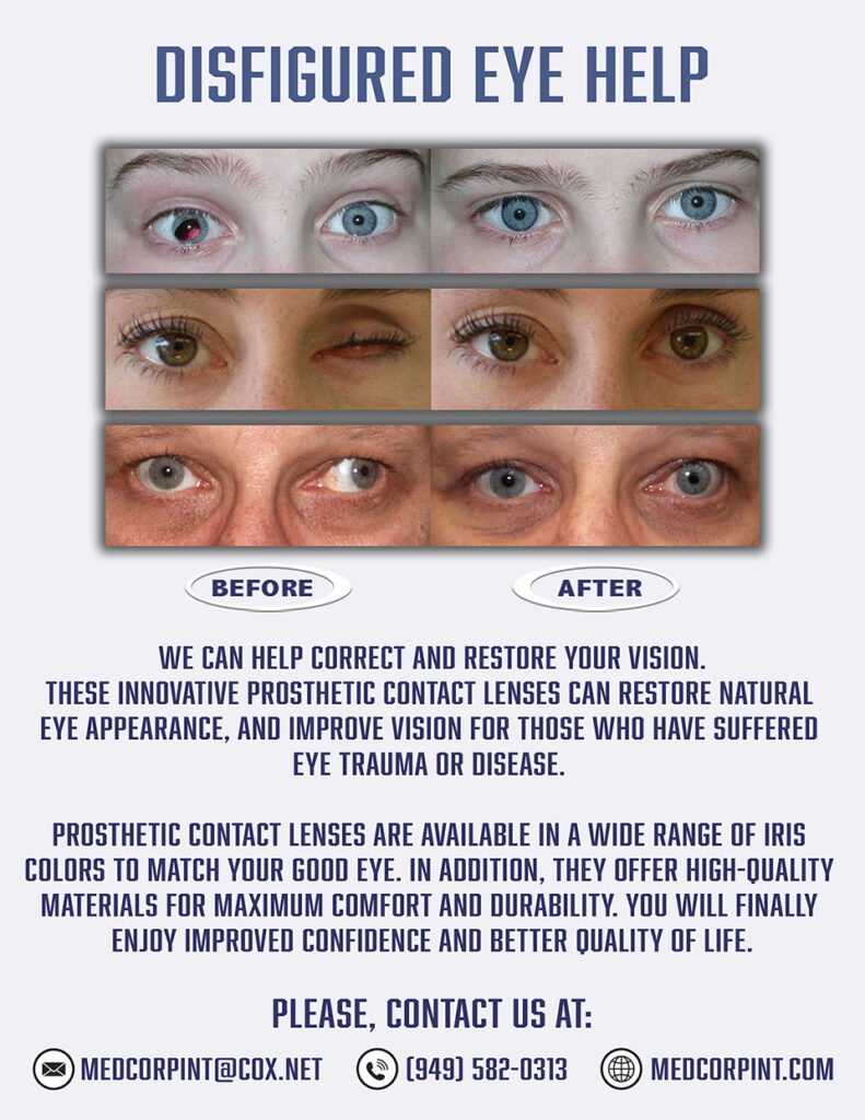 Help for people with ocular Injuries & disfigured eye problems ...